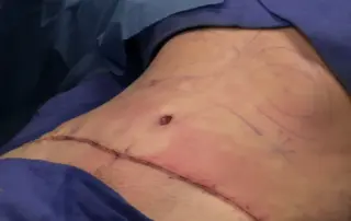 Abdominoplasty completely sutured