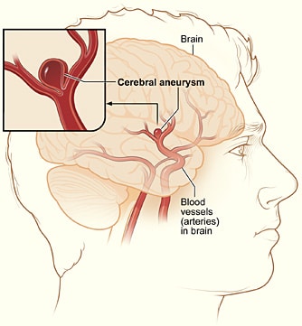 Brain Hemorrhage Malpractice Accusation - Cerebral Aneurysm